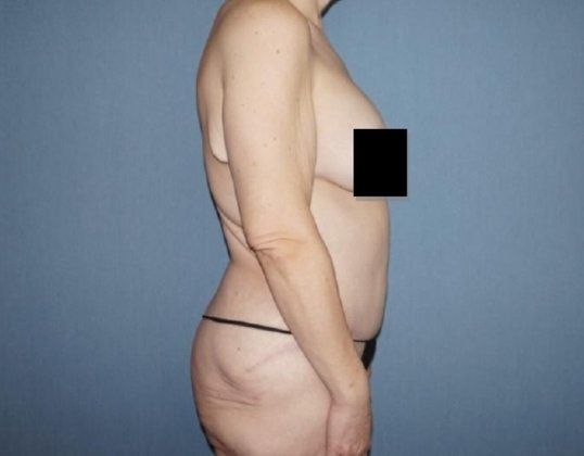 Arm Lift Before & After Image