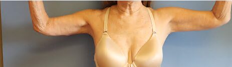 Arm Lift Before & After Image