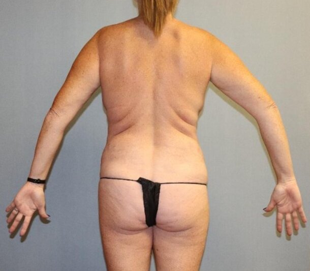 Body Lift Before & After Image