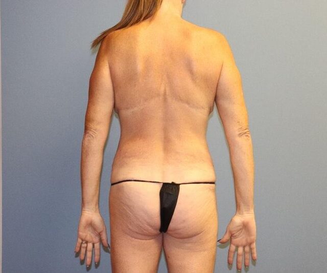 Body Lift Before & After Image