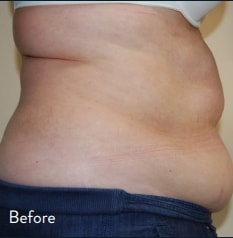 BodyTite Boston patient before and after