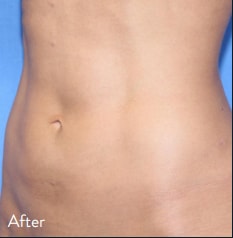 BodyTite Boston patient before and after
