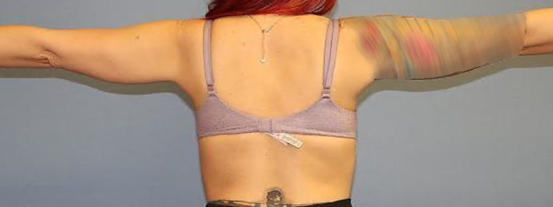 BodyTite Before & After Image