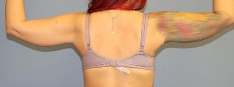 BodyTite Before & After Image