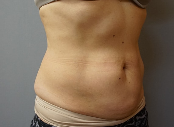 Coolsculpting Before And After Patient 1