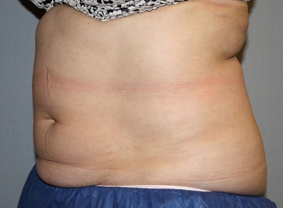 Coolsculpting Before And After Patient 2