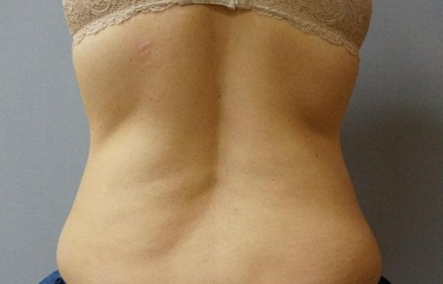 Coolsculpting Before And After Patient 4