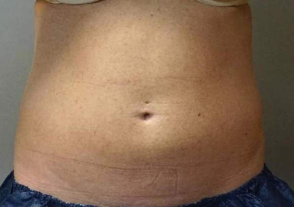 Coolsculpting Before And After Patient 6