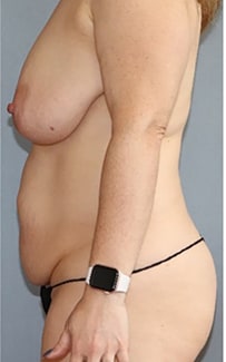 Liposuction Before And After Photo