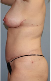 Liposuction Before And After Photo