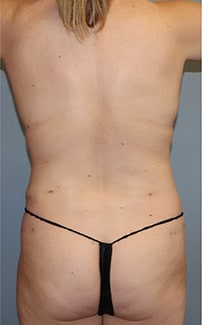 Liposuction Before And After Photo