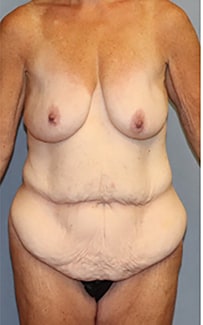 Liposuction Before And After Photo