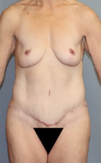 Liposuction Before And After Photo