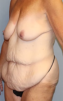 Liposuction Before And After Photo