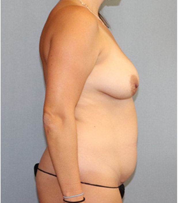 Liposuction Before And After Photo