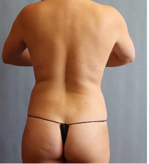 Liposuction Before And After Photo