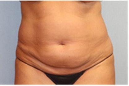 Liposuction Before And After Photo