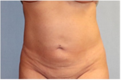 Liposuction Before And After Photo