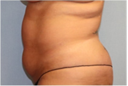 Liposuction Before And After Photo