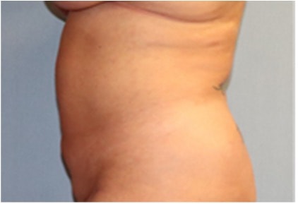 Liposuction Before And After Photo