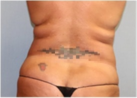 Liposuction Before And After Photo