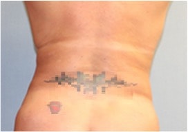 Liposuction Before And After Photo