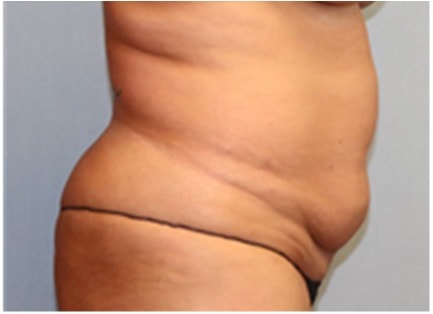 Liposuction Before And After Photo