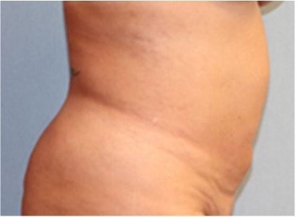 Liposuction Before And After Photo