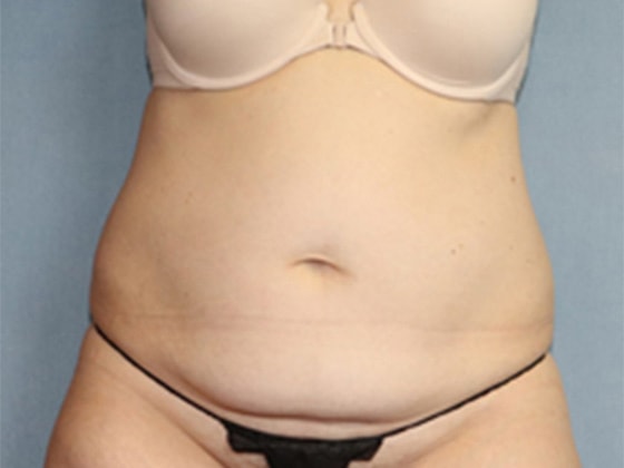 Liposuction Before And After Photo