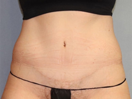 Liposuction Before And After Photo