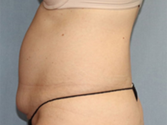 Liposuction Before And After Photo