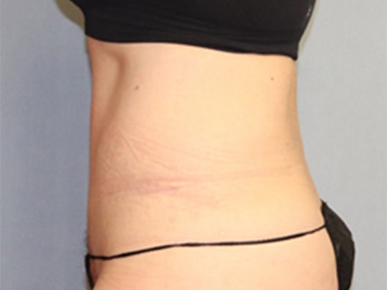 Liposuction Before And After Photo