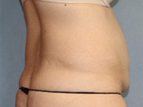 Liposuction Before And After Photo