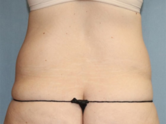 Liposuction Before And After Photo