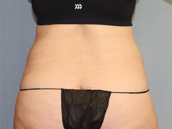 Liposuction Before And After Photo