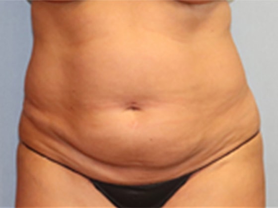 Liposuction Before And After Photo