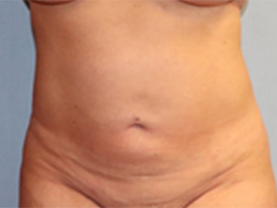 Liposuction Before And After Photo