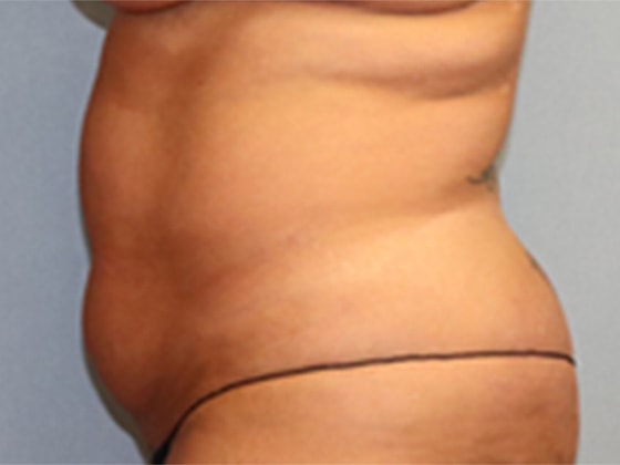 Liposuction Before And After Photo