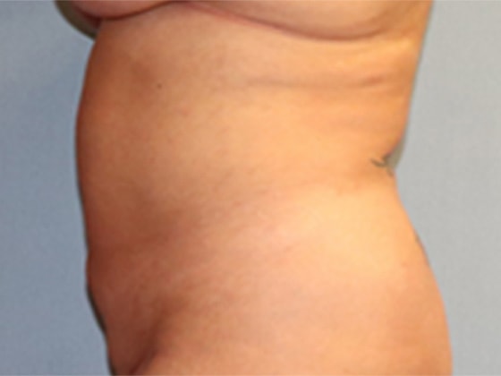 Liposuction Before And After Photo