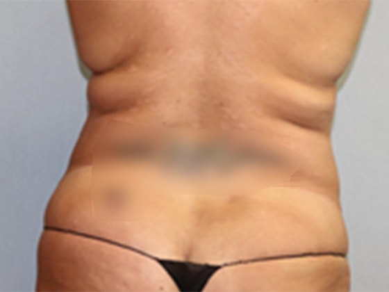 Liposuction Before And After Photo