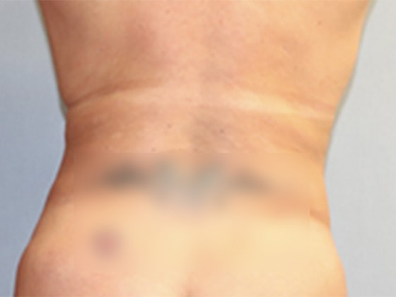 Liposuction Before And After Photo