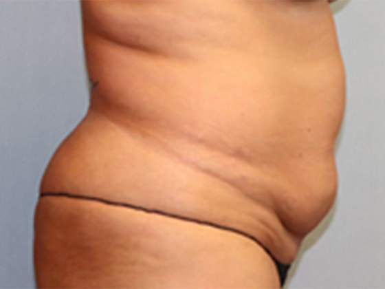 Liposuction Before And After Photo