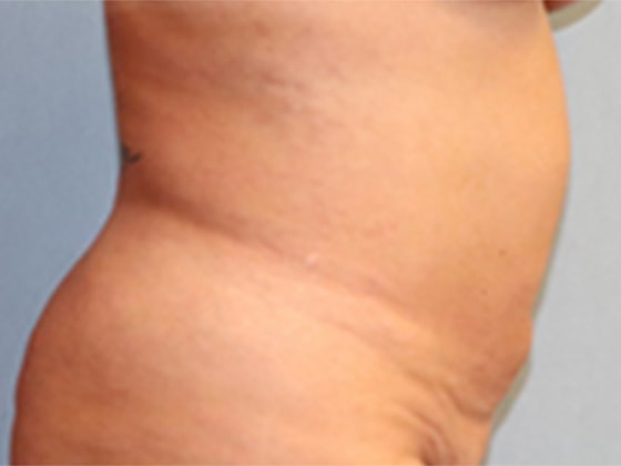 Liposuction Before And After Photo