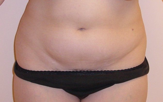 Liposuction Before And After Photo