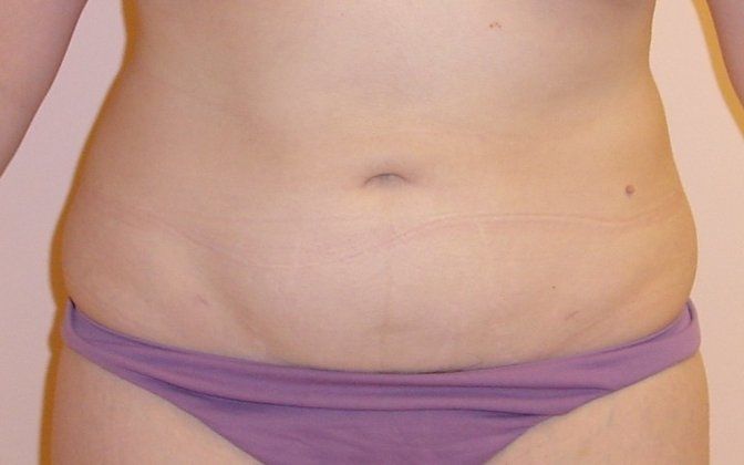 Liposuction Before And After Patient 7