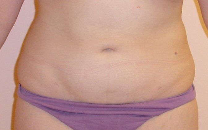 Liposuction Before And After Photo