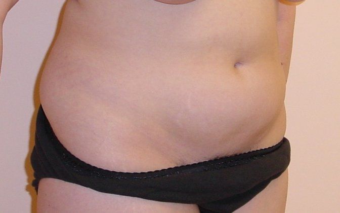 Liposuction Before And After Photo