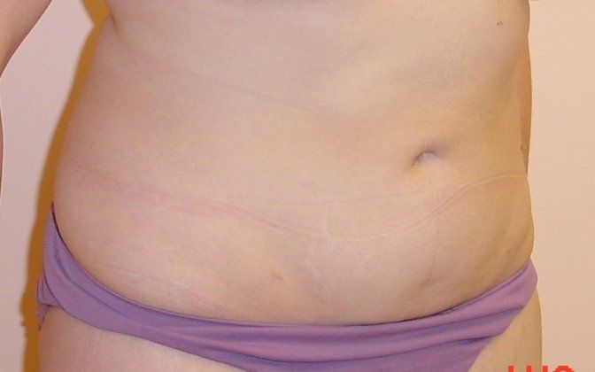 Liposuction Before And After Photo