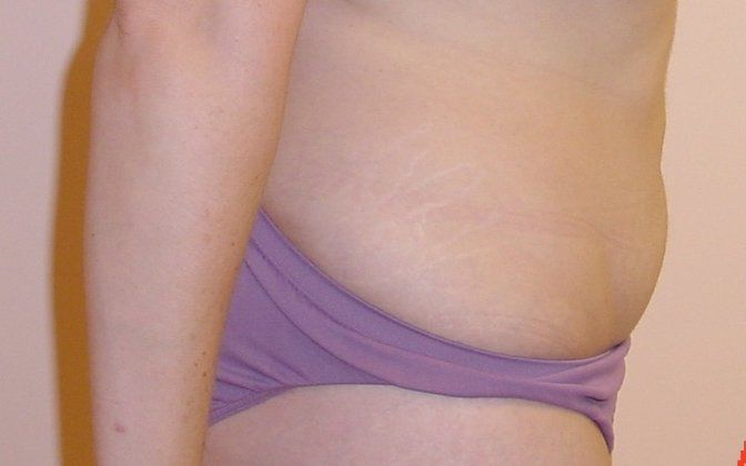 Liposuction Before And After Photo