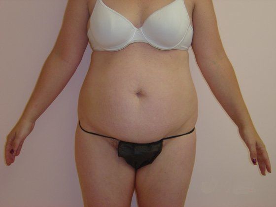 Liposuction Before And After Photo